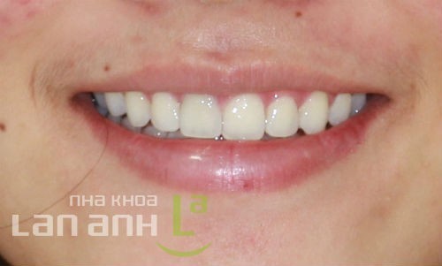 nu cuoi sau khi duoc thao mac cai chinh nha