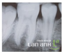 Khi cu duy tri da thao