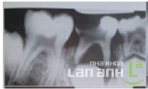 Rang coi sua bi sau