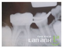 Rang vinh vien thay the