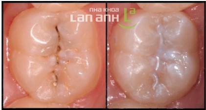 Tram bit ho ranh