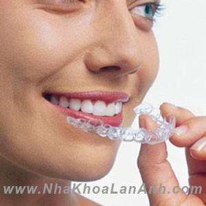 mot bo khay invisalign gom rat nhieu khay va moi khay se thich hop cho mot thoi diem nhat dinh trong chinh nha