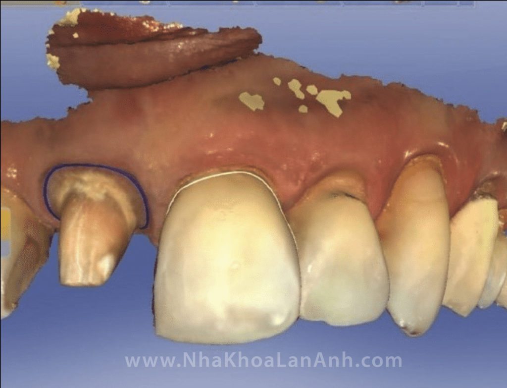 Hình: Hình ảnh scan trực tiếp là hình ảnh màu, hiển thị rõ hình dạng răng đã mài, răng thật xung quanh, từ đó bác sĩ và kỹ thuật viên sẽ 