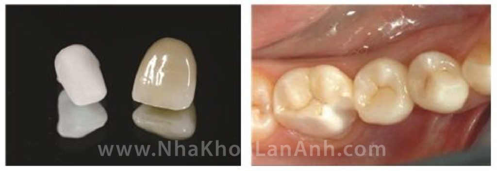Hình: Khung sườn Zirconia trước và sau khi đắp sứ. Do màu của Zirconia đục và không đẹp, nên thường được kỹ thuật viên đắp lớp sứ lên để tăng tính thẩm mỹ. Tuy vậy, lớp sứ đắp này lại không quá cứng chắc, nên bệnh nhân có thể gặp tình trạng bể, mẻ phần sứ đắp trên Zirconia (hình dưới).