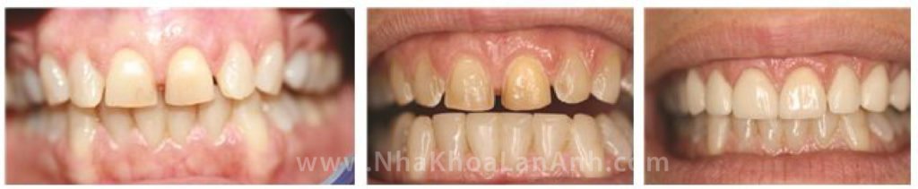 Hình: Răng nhỏ, thưa và hở kẽ chỉ cần mài một lớp mỏng ở phía trước để làm Veneer 