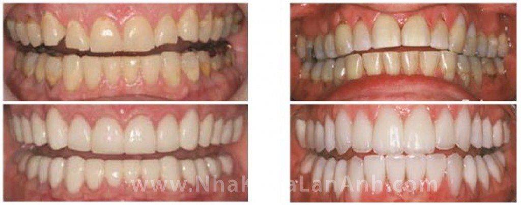 Mau-sac-tham-my-cua-rang-su-Cerec-1 nha khoa, tag: nha khoa tốt ở tphcm