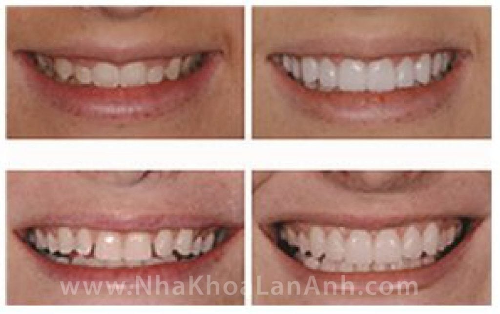 Mau-sac-tham-my-cua-rang-su-Cerec-2 nha khoa