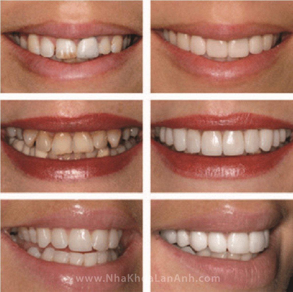 Mau-sac-tham-my-cua-rang-su-Cerec-4-nha khoa