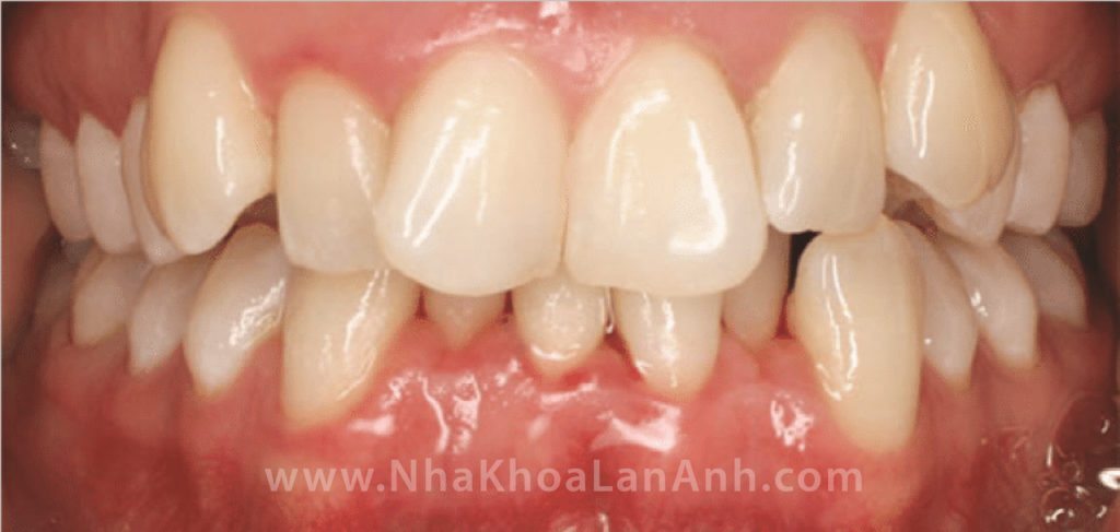 Hình: Những trường hợp răng lệch lạc nhiều như răng cửa dưới chen chúc, hoặc chen chúc cả 2 hàm vùng răng cửa, bạn nên chỉnh nha để đưa răng về vị trí đúng. Thời gian chỉnh nha khoảng 18 tháng nhưng kết quả đem lại sẽ rất tốt. Nếu bạn ngại đeo mắc cài, hãy nghĩ đến Invisalign!