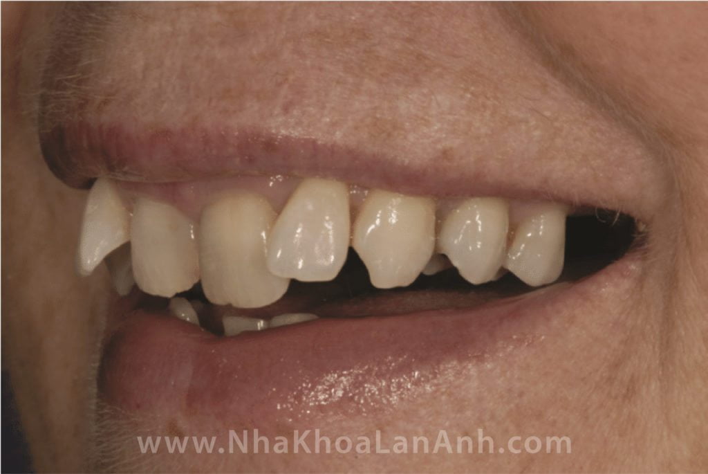 Hình: Răng cửa giữa trục răng nghiêng vào trong, mong muốn làm dày lên nên bác sĩ chỉ cần mài ít và bảo tồn tủy răng. Ngược lại, răng cửa bên chìa ra trước, bác sĩ sẽ phải lấy tủy 2 răng cửa bên để 