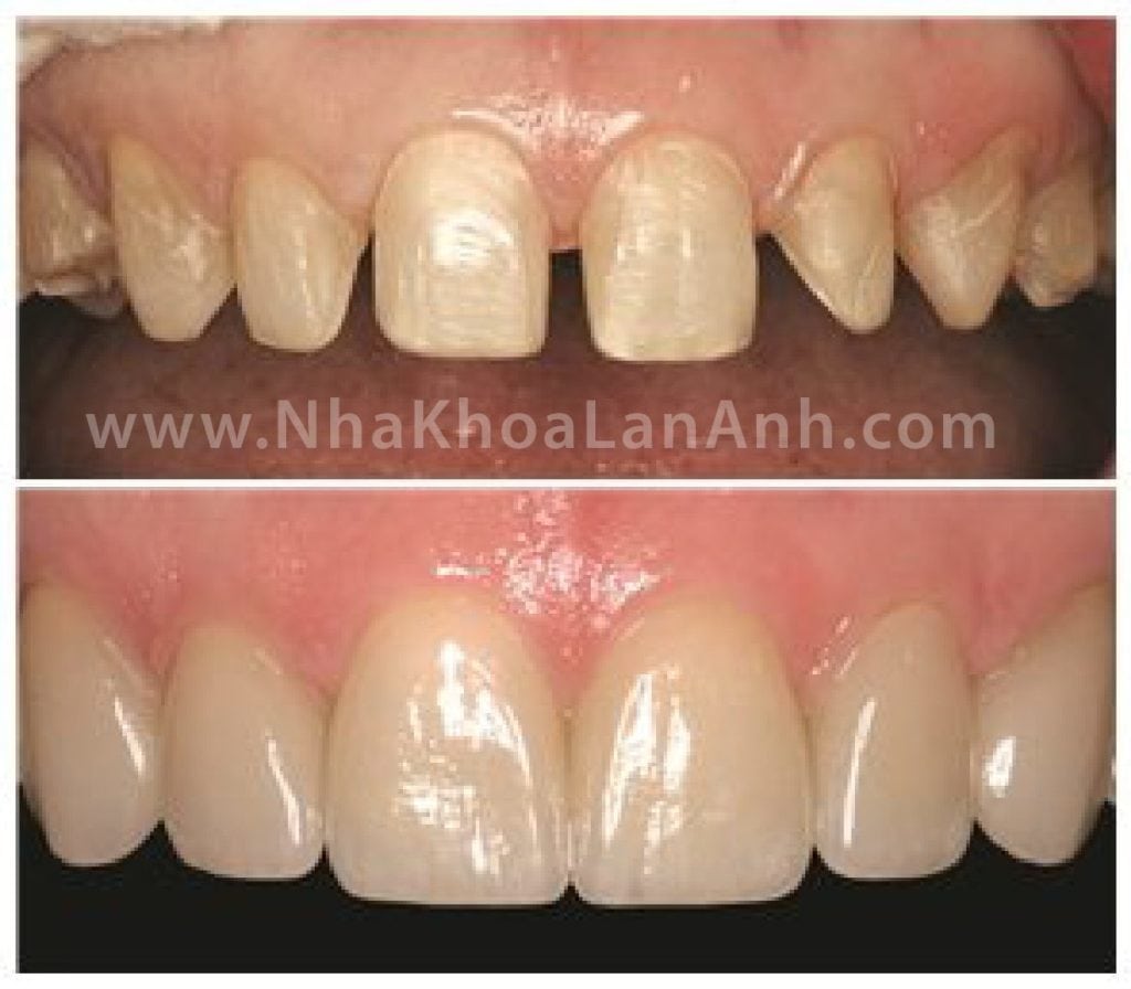 Hình: Veneer sau khi mài và sau khi gắn trên răng thật. Răng thật được bảo tồn tối đa.