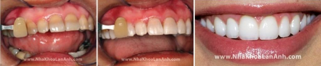 Sau khi tay trang va lam veneer