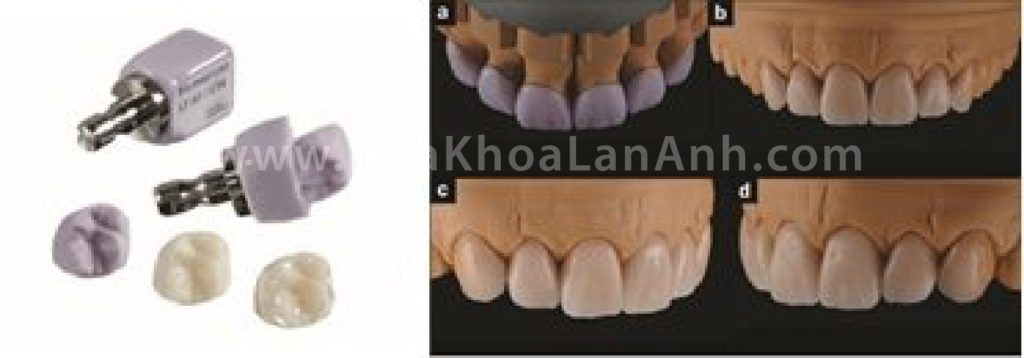 Hình: Thỏi sứ Emax CAD được sử dụng tại nha khoa Lan Anh. Loại sứ này có đặc điểm thẩm mỹ cao, nhiều màu sắc để chọn lựa (riêng màu trắng để làm phục hình toàn hàm là 11 màu). Độ cứng của Emax CAD cũng rất tốt để có thể làm được Veneer hay mão sứ cần độ mỏng cao, từ 0.4-0.8mm.