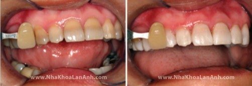 truong hop rang nhiem tetracycline, tay trang rang bang den zoom cho ket qua han che.