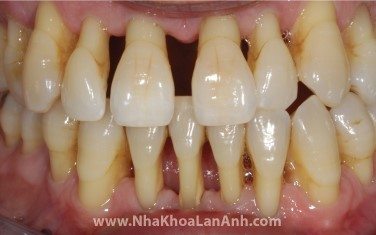rang bi benh nha chu, chan rang yeu dan, xuong quanh rang bi tieu lam cho rang bi lung lay. truong hop nay bac si se khuyen benh nhan chuan bi cho mot ke hoach trong rang implant tuong lai, thay vi co gang dieu tri giu lai rang.