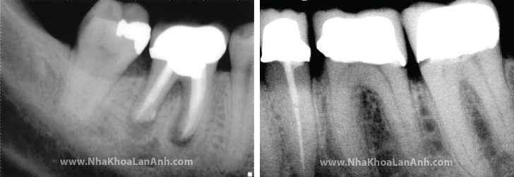 rang-bi-nhiem-trung-chan-rang trong rang implant. tag: gia rang su