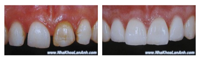  gia rang su, Phuc hinh rang cua thua bang veneer su. tag: gia rang su, rang su nao tot,làm răng sứ ở đâu tốt