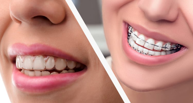 hinh-anh-nieng-rang-bang-khay-invisalign-4